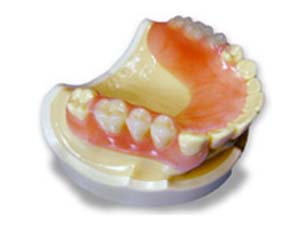 ノンクラスプデンチャー