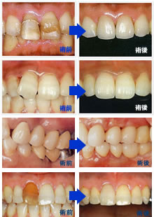 エンプレス(エンジェルクラウン)単色オールセラミック術前・術後