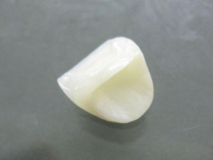 オールセラミック