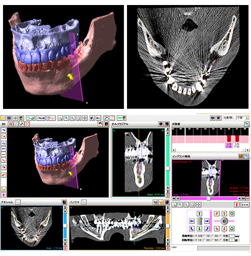 歯科用CT(3Dレントゲン)