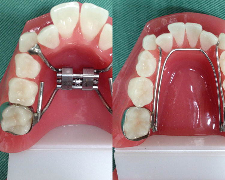 スケルトン矯正の利点