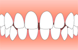 空隙歯列(くうげきしれつ)・正中離開(せいちゅうりかい)