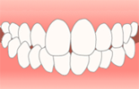 交叉咬合(こうさこうごう)