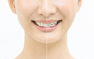 インビザラインによる矯正治療とは