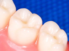 歯を強くするフッ素塗布