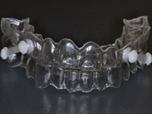 歯科医院におけるマウスピース療法