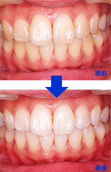 デュアルホワイトニング術前・術後