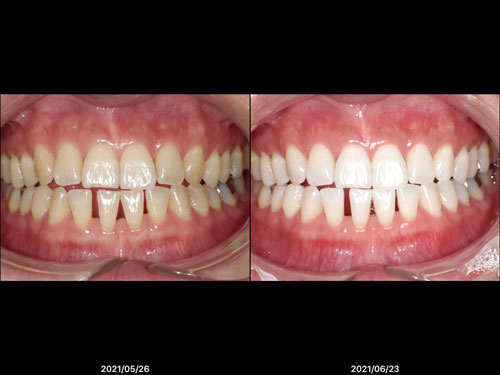 デュアルホワイトニング術前・術後