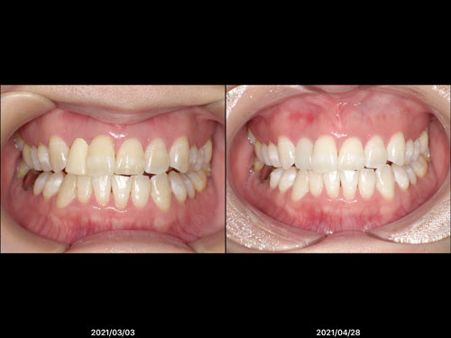 デュアルホワイトニング術前・術後